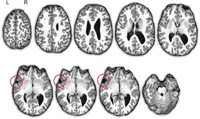 Developmental Dynamic Dysphasia: Are Bilateral Brain Abnormalities a Signature of Inefficient Neural Plasticity?